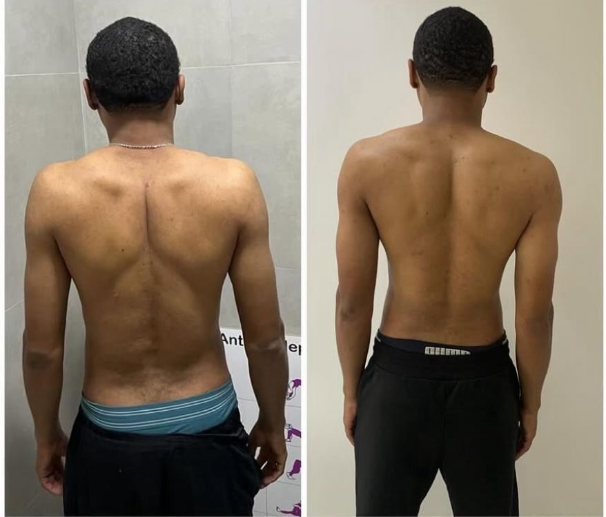 Antes e depois - melhora de mobilidade e postura